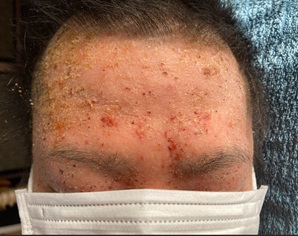 20年越しのアトピーを克服　掛川市Hさん28才